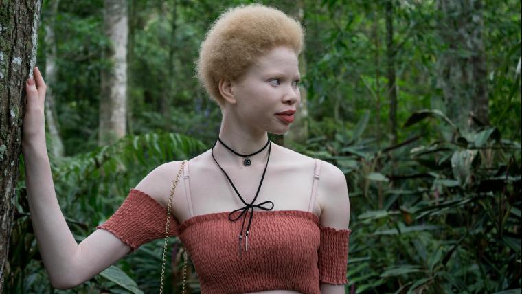 “What makes you different makes you beautiful.” Watch how this woman with albinism overcame online bullying